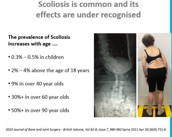 Scoliosis In Adults Is No Big Deal Or Is It Scolitech